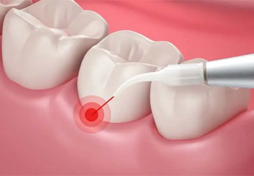 Laser in Oral Surgery