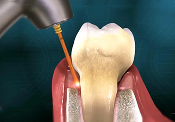 Laser in Periodontics