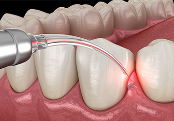Laser in Prosthodontics